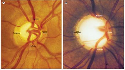 Fundus photographs of healthy and glaucomatous optic nerve heads 