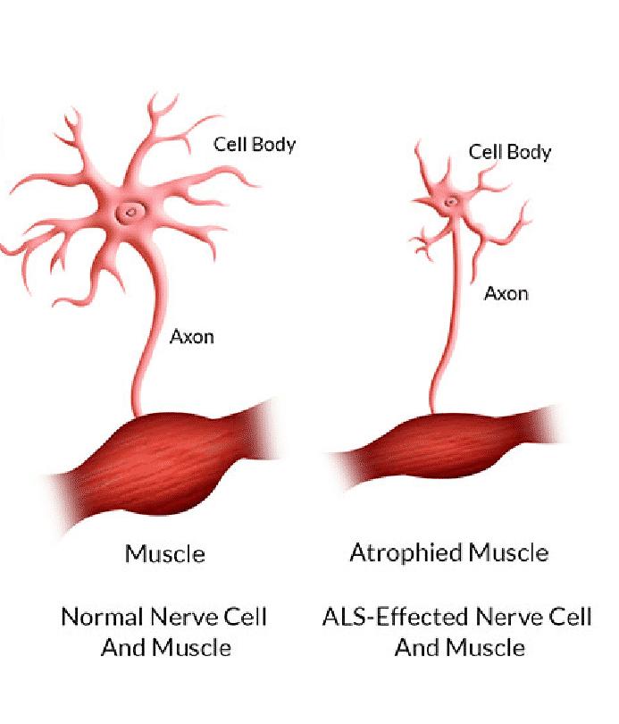 Understanding ALS: The Role of Gene Therapy in Treating Amyotrophic ...