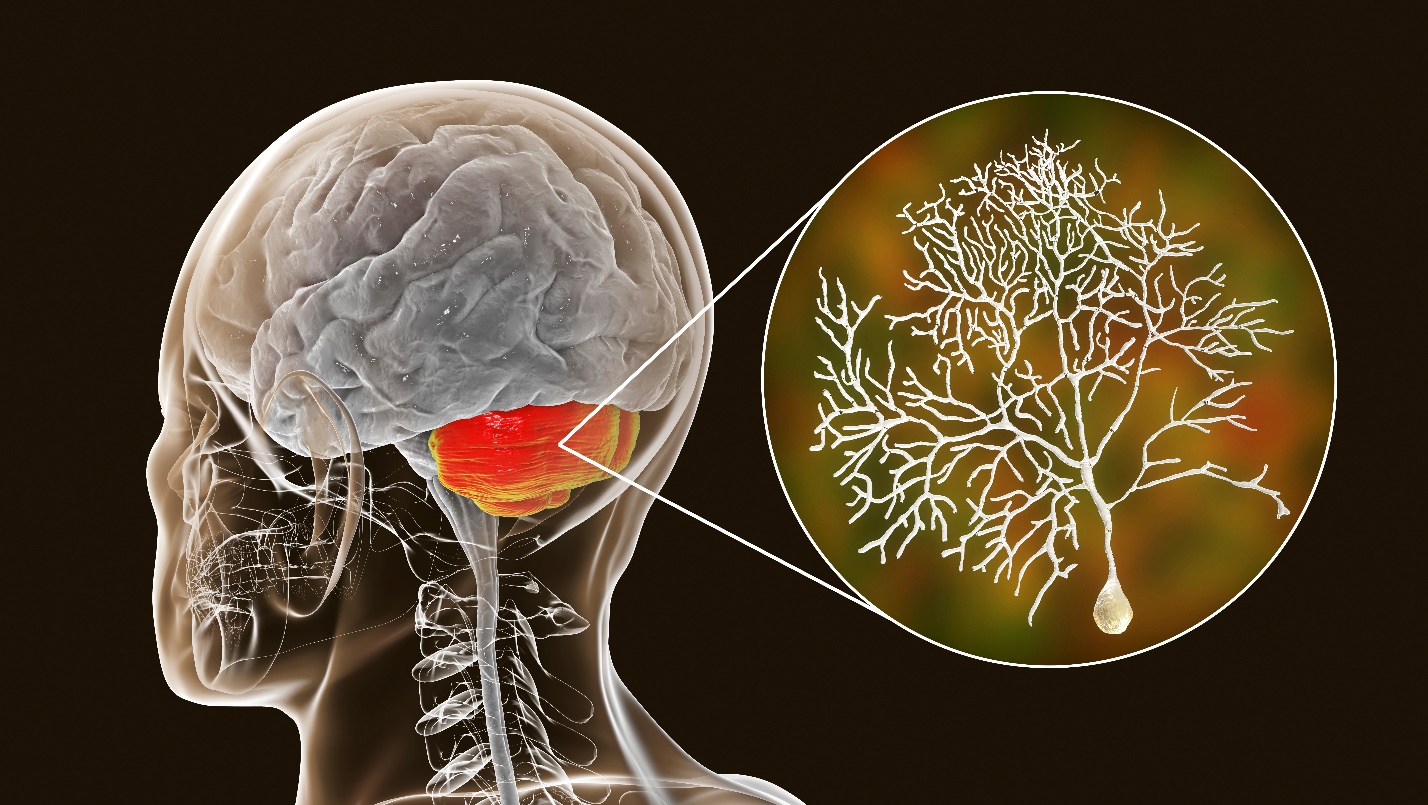 Lexeo Therapeutics Announces Promising Interim Results in Friedreich Ataxia Cardiomyopathy Trials